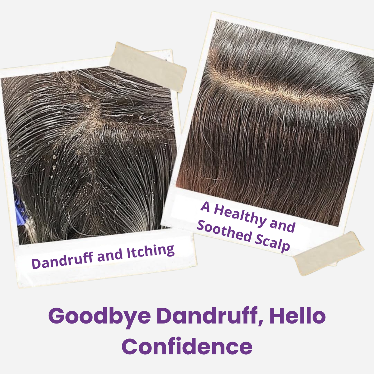 Dandruff-Fighting Comb - Say Goodbye to Dandruff & Hair Fall! Buy 1, Get 1 Free