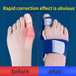 Bunion Toe Shaper For Men & Women - Free Size