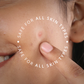 InvisiClear™ Acne Hydrocolloid Pimple Patch
