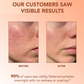 InvisiClear™ Acne Hydrocolloid Pimple Patch