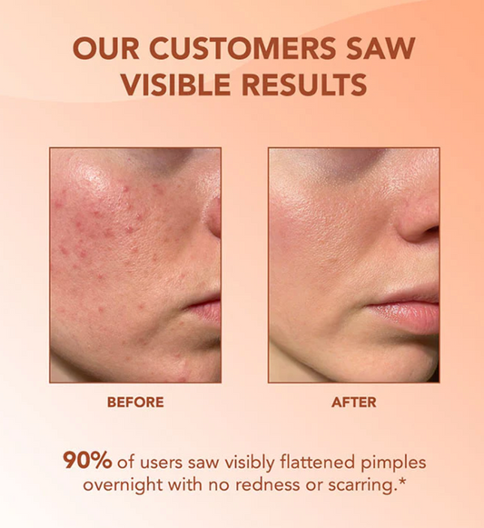 InvisiClear™ Acne Hydrocolloid Pimple Patch